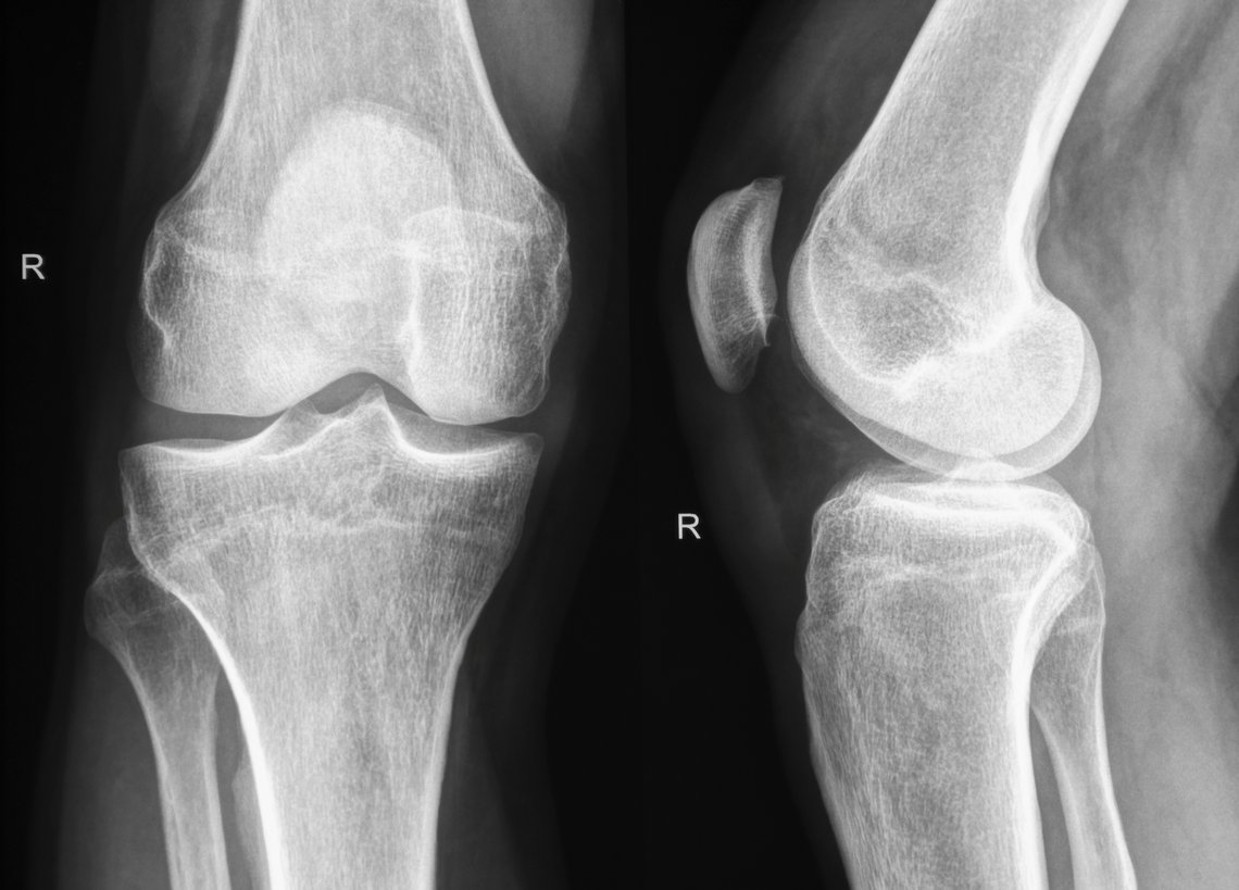 Röntgenbild rechtes Knie
