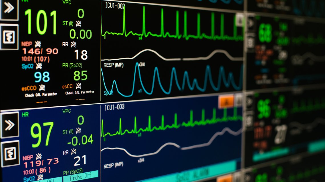 Überwachungsmonitor auf der Intensivstation
