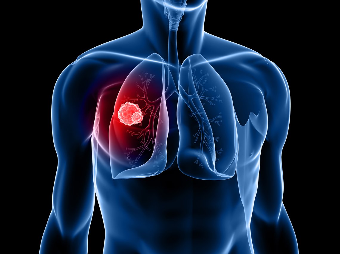 Transparenter Körper mit Lungentumor