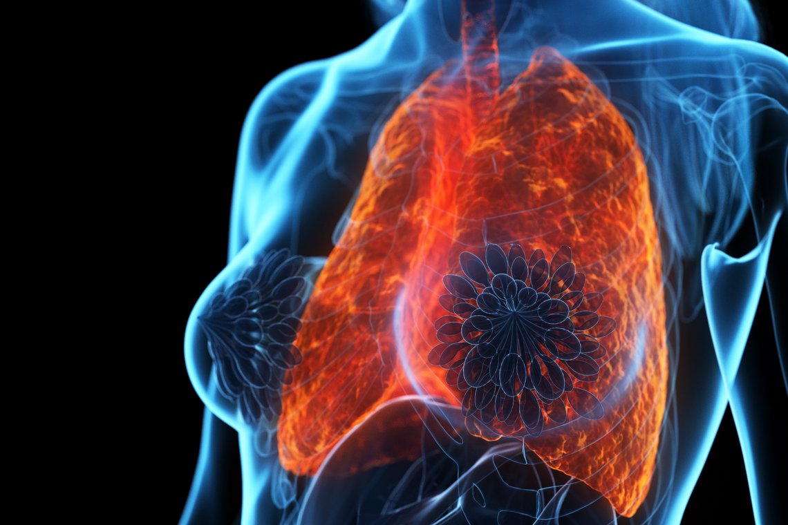 3D Darstellung einer kranken Lunge